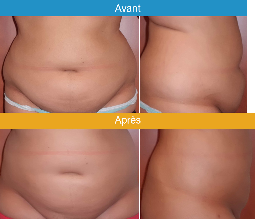 abdominoplastie-2.jpg