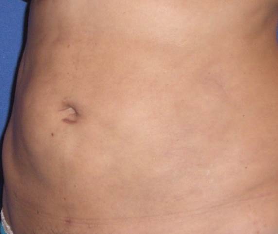 abdominoplastie-photo-2.jpg