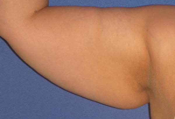 Chirurgie des bras - Lifting et chirurgie esthetique des bras
