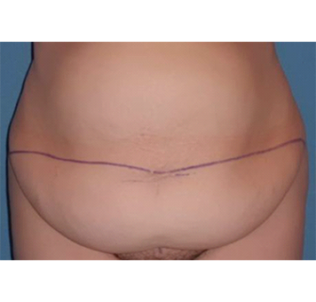 interventions-abdominoplastie.png