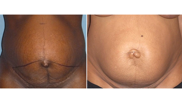 chirurgie du ventre Paris | liposuccion | plastie abdominale ...