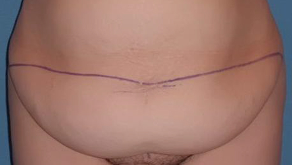 chirurgie du ventre Paris | liposuccion | plastie abdominale ...